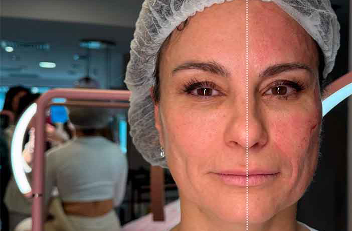 COMPRAR EXOSOMAS PARA DERMAPEN
