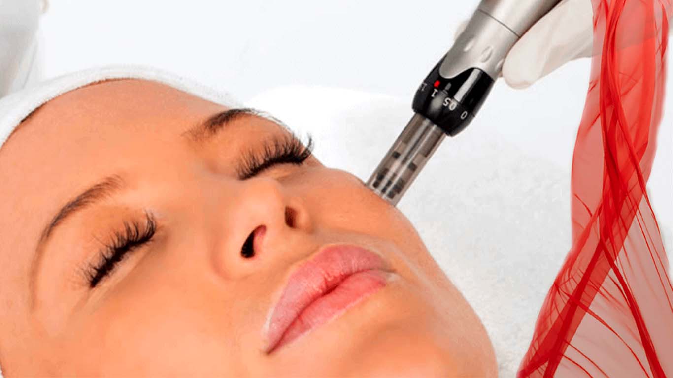 Exosomas con Dermapen